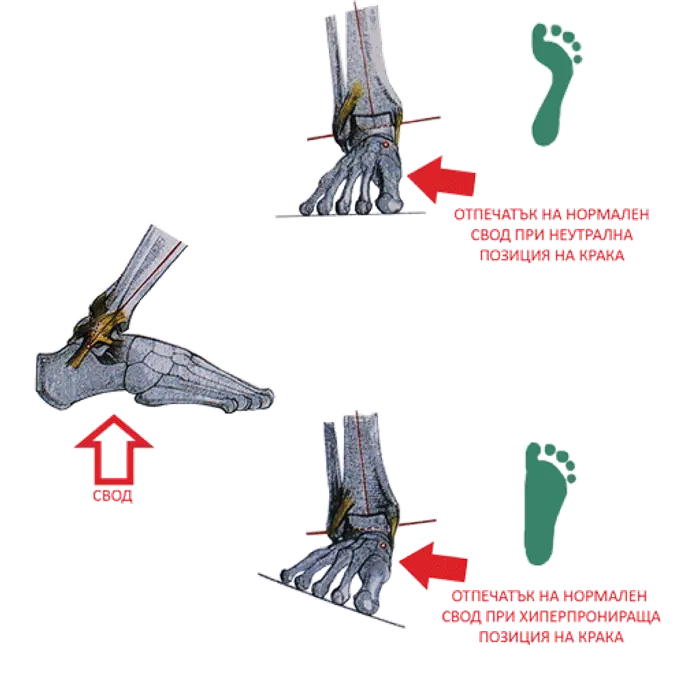 плоскостъпие или пронация
