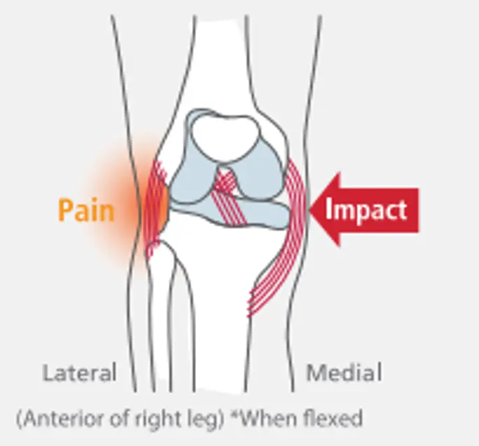 Травма на латерална колатерална връзка